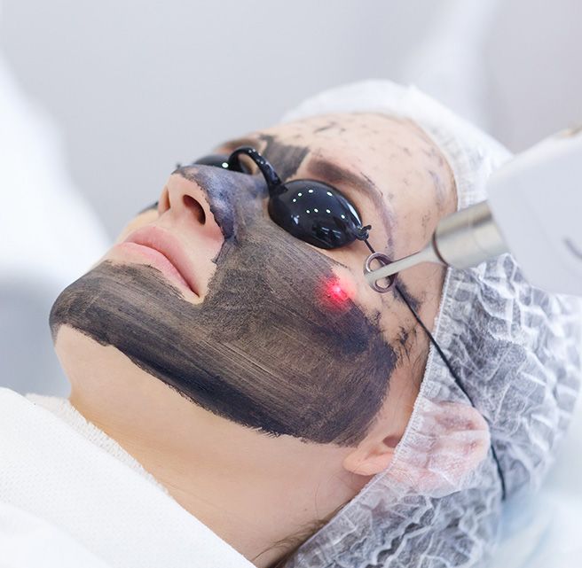 Carbon Laser Facial